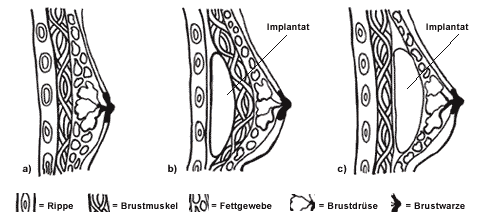 Brustvergrößerung - Schematische Darstellung