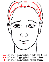 Oberes Facelift (Stirnlift)