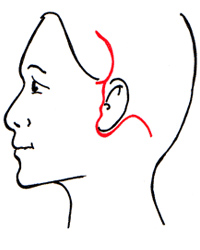 Unteres Facelift
